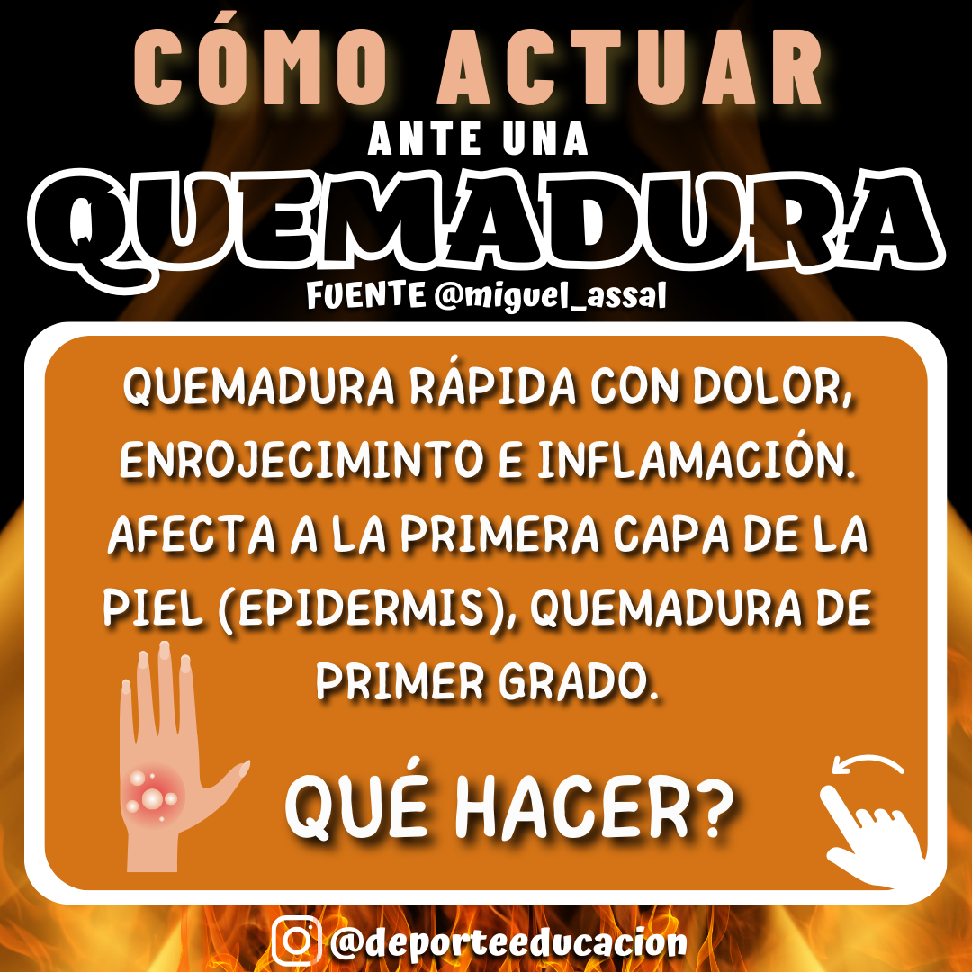 CÓMO ACTUAR ANTE QUEMADURAS DE PRIMER GRADO