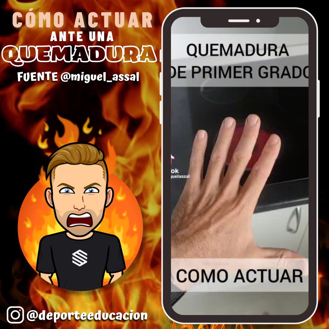 CÓMO ACTUAR ANTE QUEMADURAS DE PRIMER GRADO